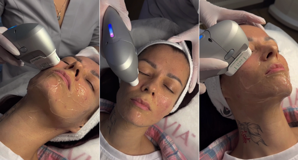 Ультразвуковой SMAS-лифтинг на аппарате Ultraformer