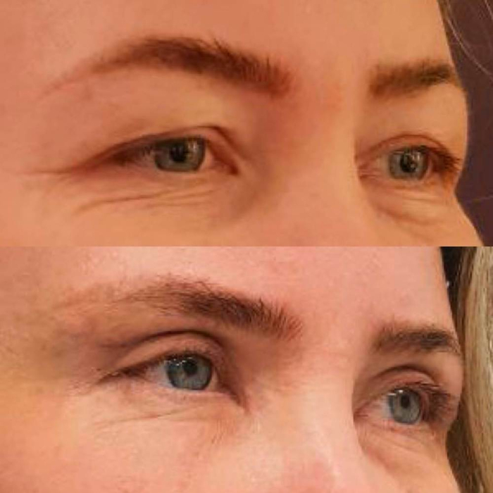 Пациентка хирурга Лилит Чолоян до и после верхней блефаропластики