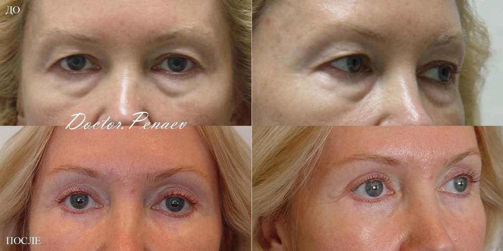 Пациентка клиники NBС до и после круговой блефаропластики