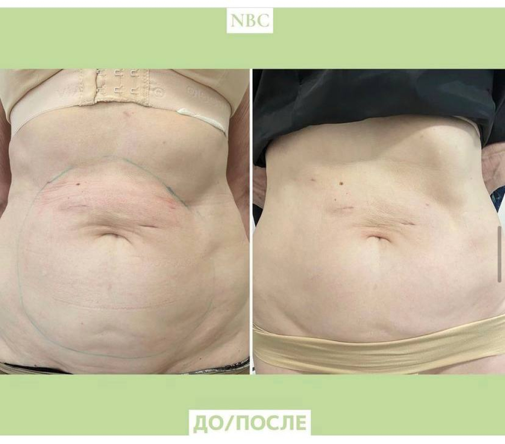 Пациентка до и сразу после процедуры на аппарате Ulfit