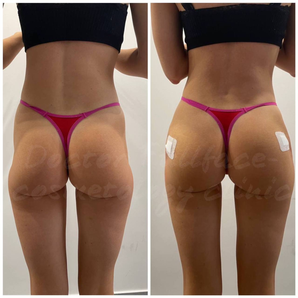 Фото пациентки доктора Татьяны Печерицыной до и после увеличения ягодиц филлерами