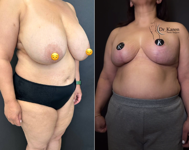 Пациентка пластического хирурга Карена Пайтяна до и после операции операции по уменьшению груди