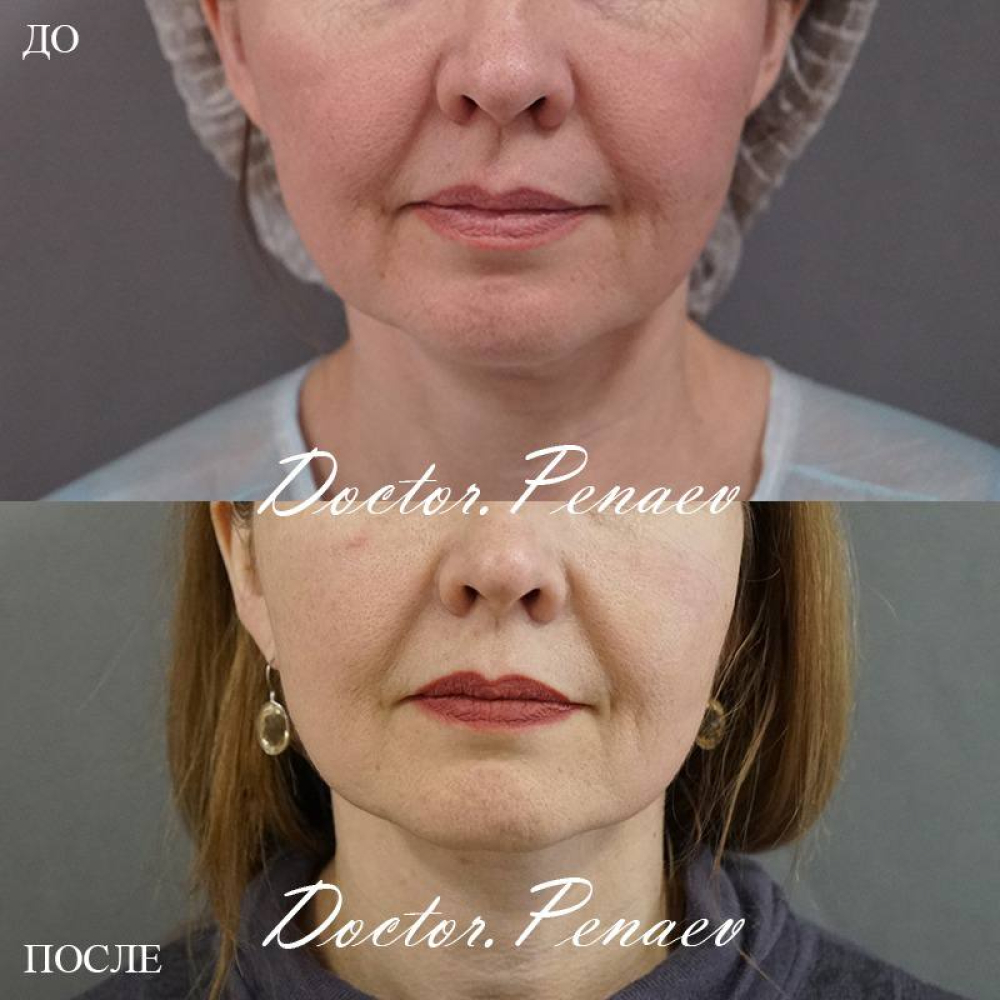 Омоложение лица Арслан Пенаев