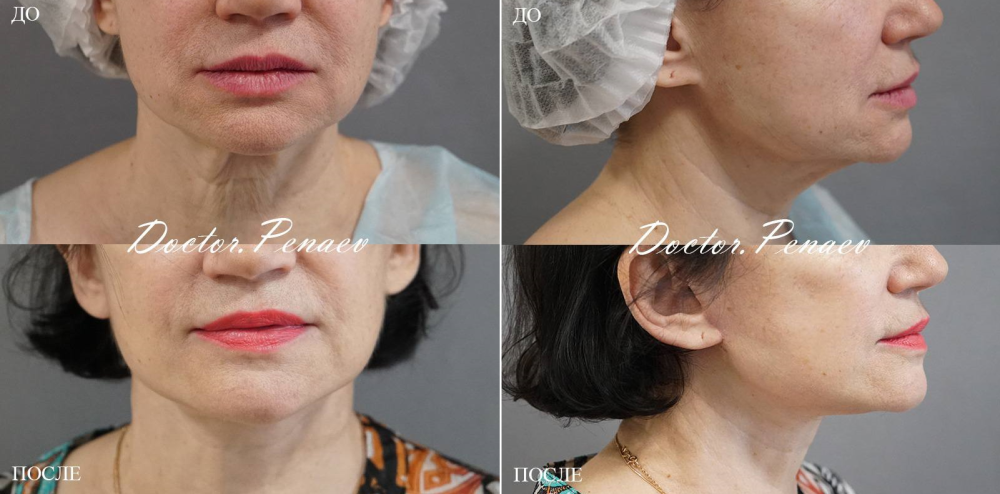 Пациентка пластического хирурга Арслана Пенаева до и после омоложения лица