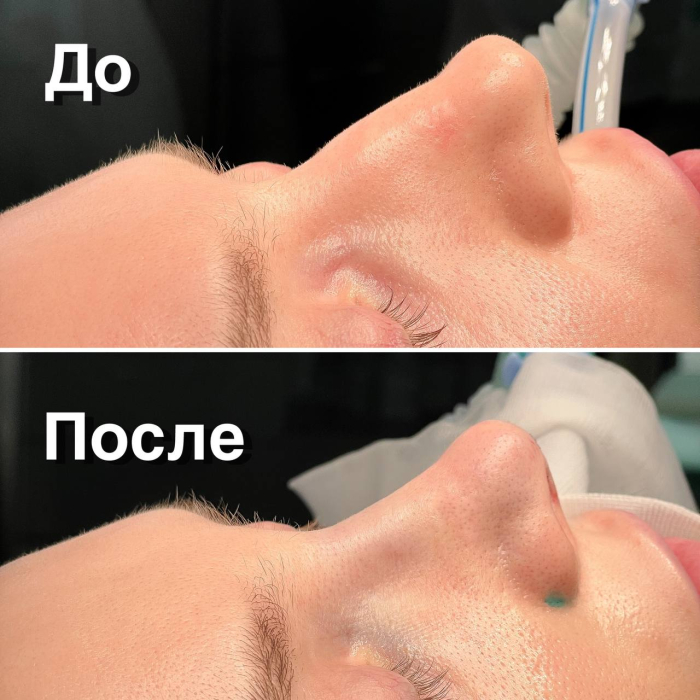 Пациентка пластического хирурга Валерия Стайсупова до и после закрытой ринопластики