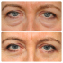 Микрохирургическая блефаропластика от Лилит Чолоян