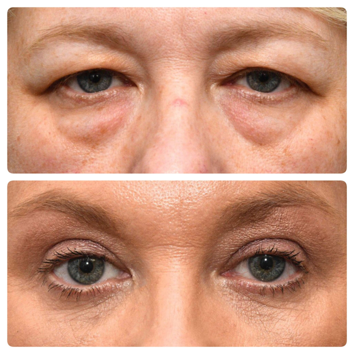 Микрохирургическая блефаропластика от Лилит Чолоян