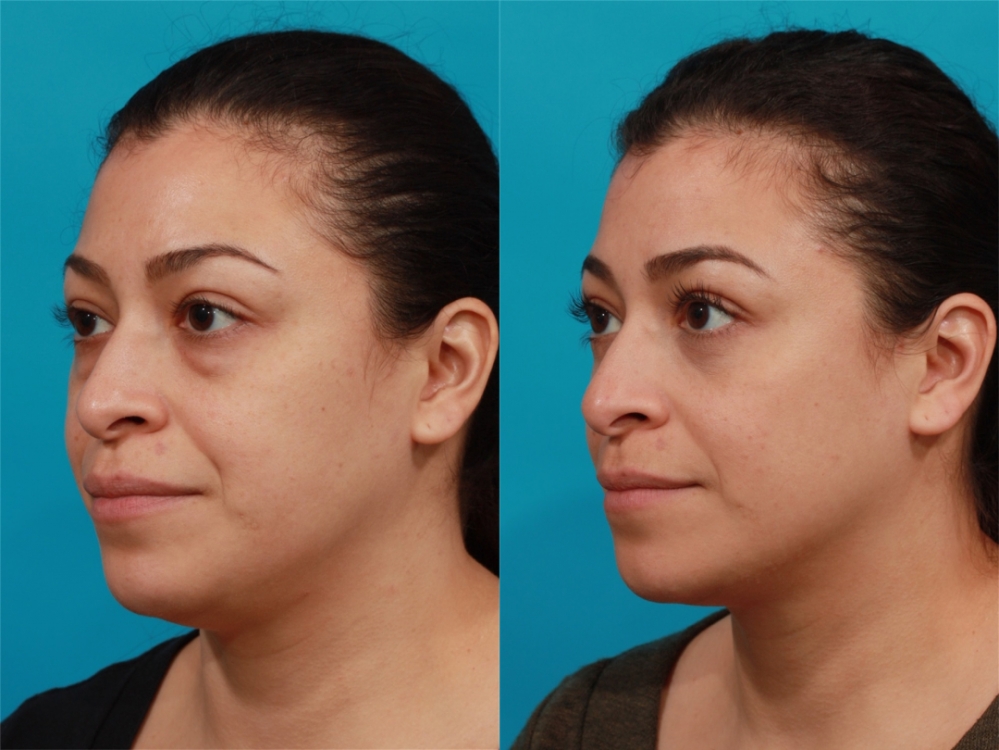 Пациентка пластического хирурга Гукаса Миракяна до и после блефаропластики