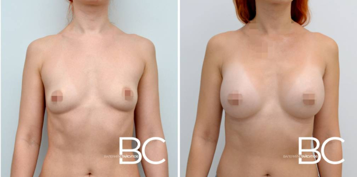 увеличение груди до и после