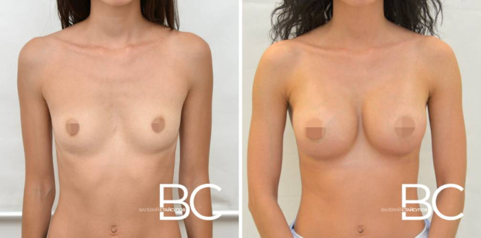 Пациентка доктора В. Стайсупова до и после увеличения груди