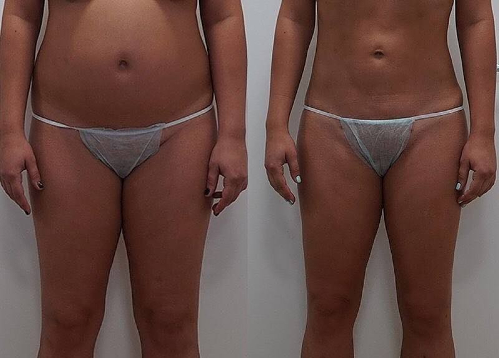 VASER и Body Tite-липосакция с липотрансфером ягодиц