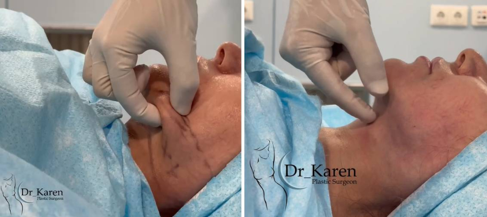 липомоделирование подбородка Карен Пайтян