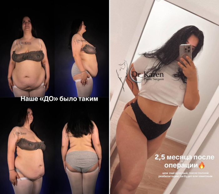 Пациентка доктора Карена Пайтяна до и после абдоминопластики