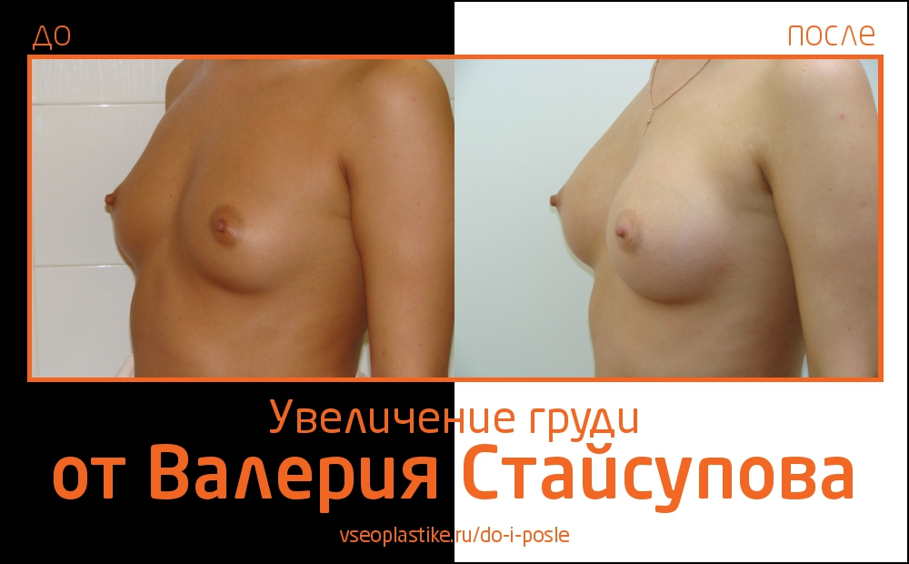 Пациентка увеличила грудь в Институте красоты СПИК у Валерия Стайсупова. В ходе операции ей были установлены круглые импланты Natrelle (МакГан), 275 сс.
