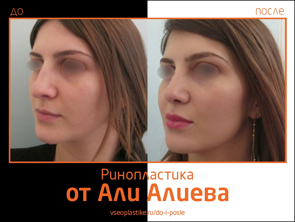 Али Алиев ринопластика до и после