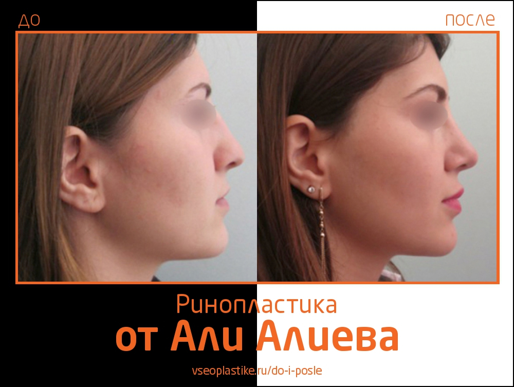 Али Алиев ринопластика до и после