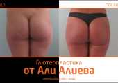 Aliev_glyuteo_2
