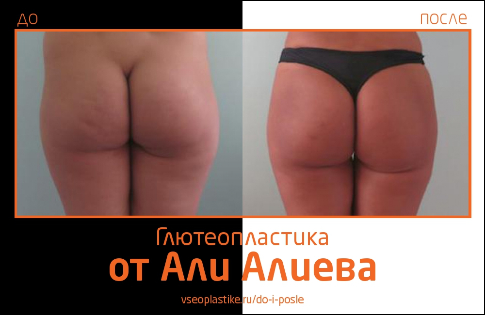 Aliev_glyuteo_2