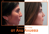 Aliev_rino_4