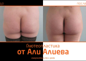 Aliev_glyuteo_1
