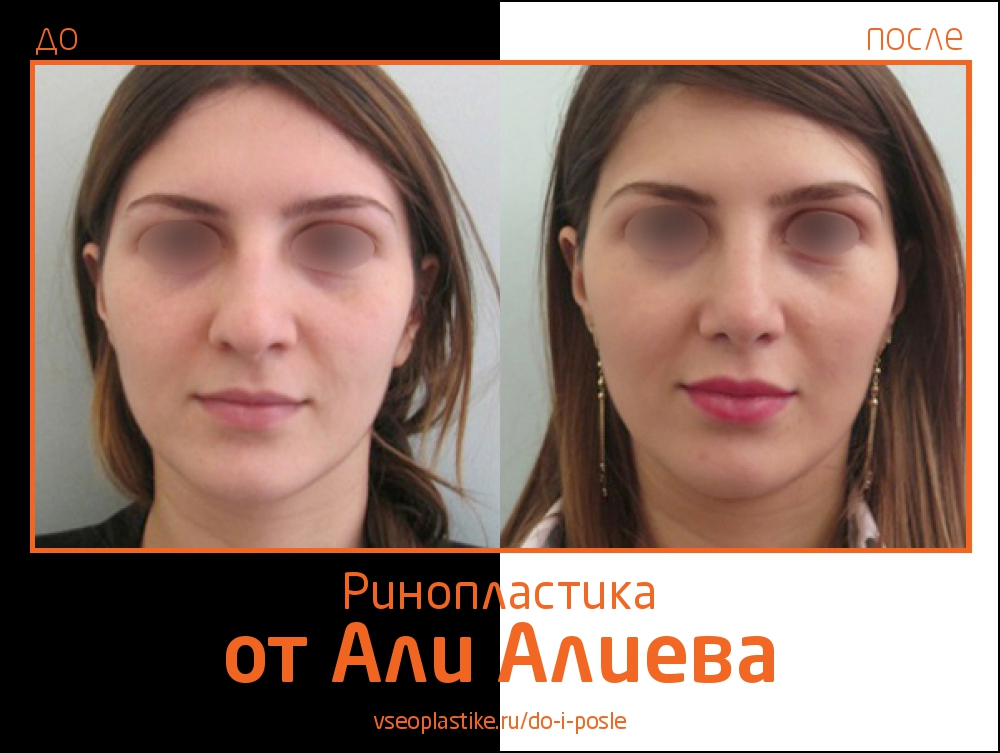 Али Алиев ринопластика до и после