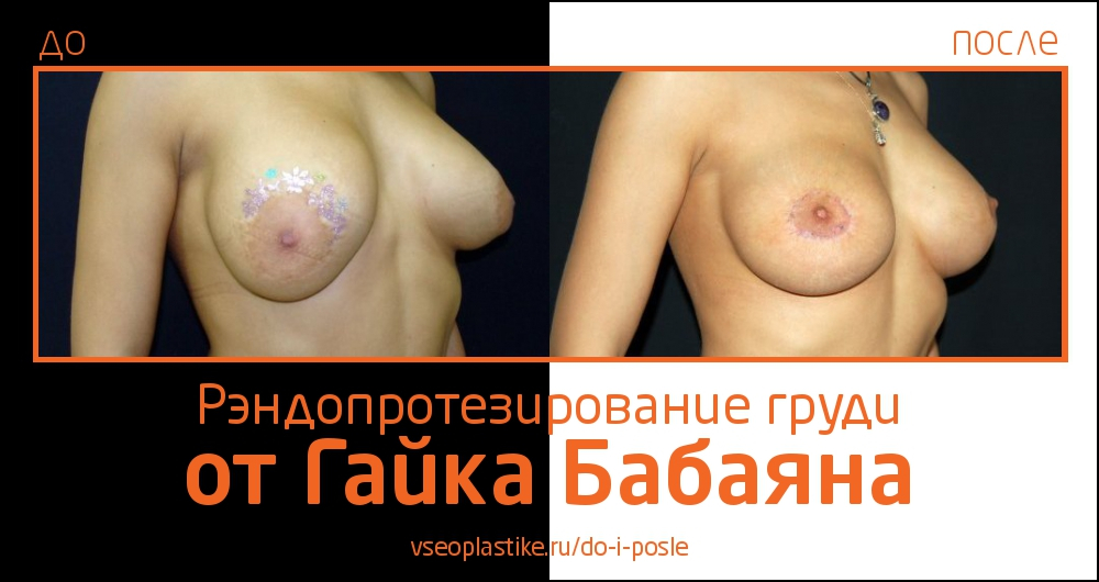 До и после рэндопротезирования груди у Гайка Бабаяна