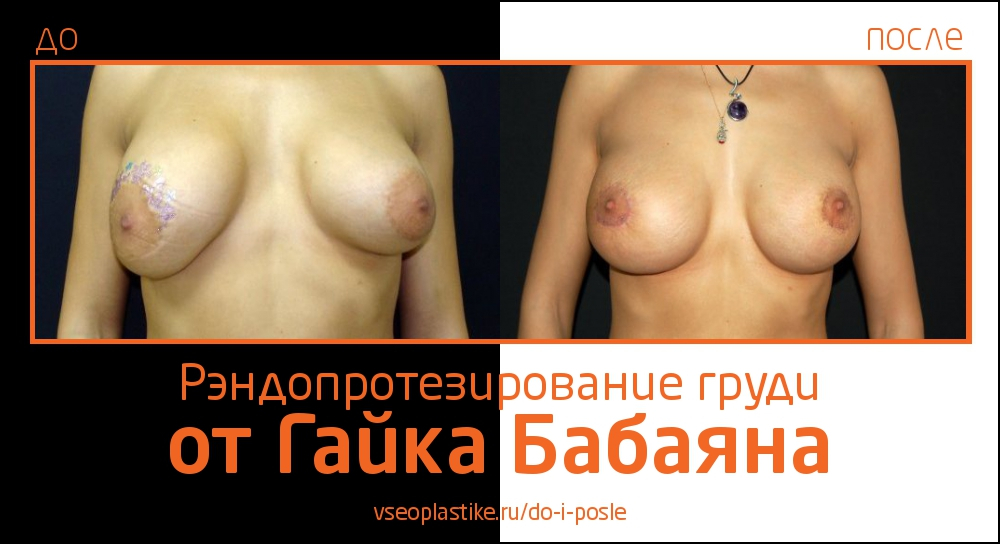 До и после рэндопротезирования груди у Гайка Бабаяна