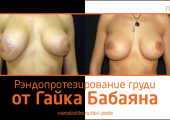 До и после рэндопротезирования груди у Гайка Бабаяна