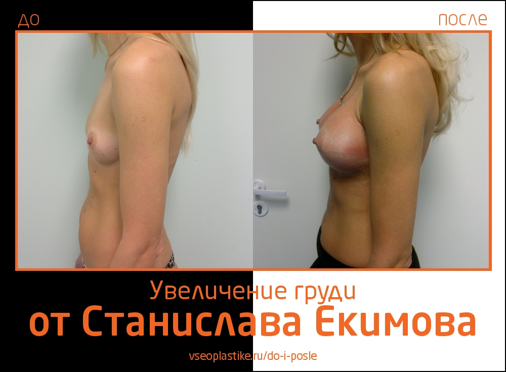 Станислав Екимов. Фото до и после увеличения груди