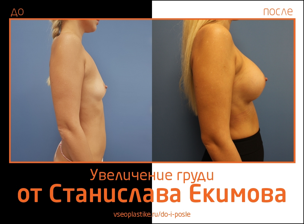 Станислав Екимов увеличение груди