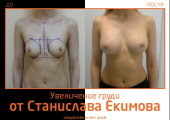 Станислав Екимов. Фото до и после увеличения груди