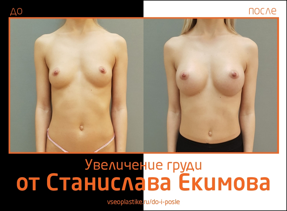 Станислав Екимов фото до и после увеличение груди