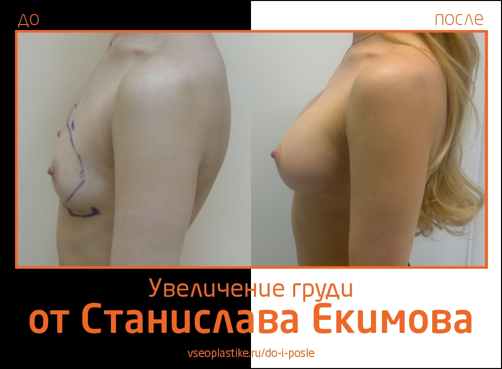 Станислав Екимов. Фото до и после увеличения груди