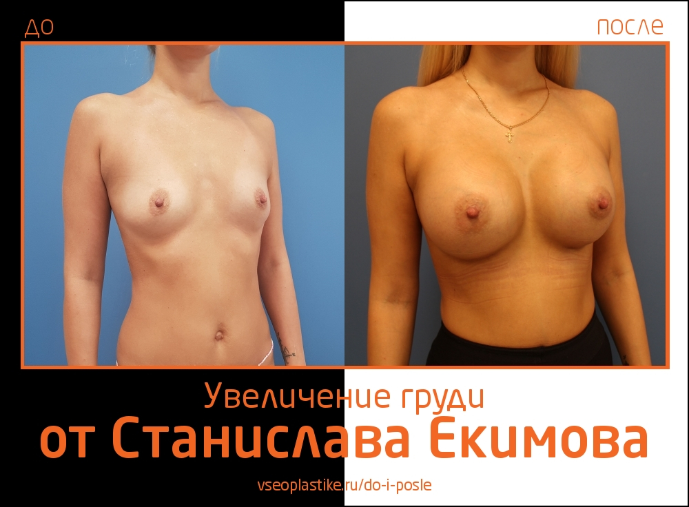 Станислав Екимов увеличение груди