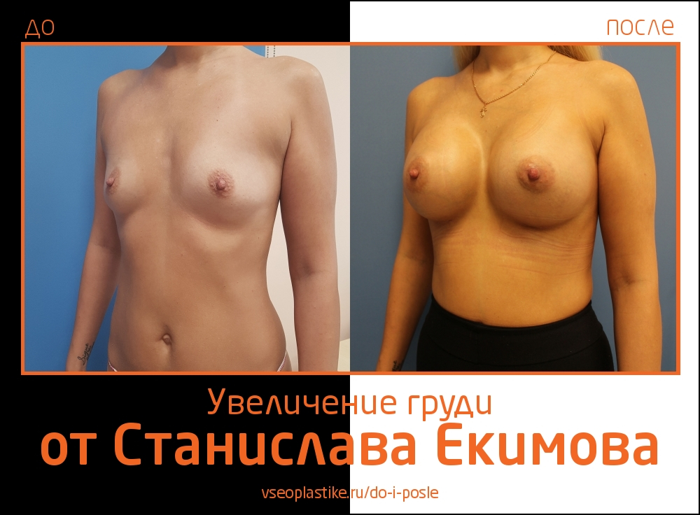 Станислав Екимов увеличение груди