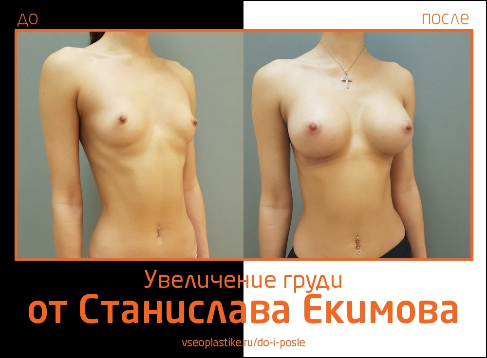 Станислав Екимов. Фото до и после увеличения груди