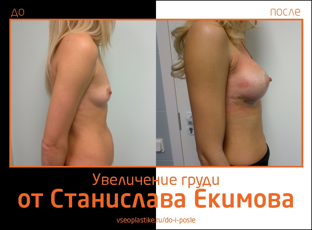 Станислав Екимов. Фото до и после увеличения груди
