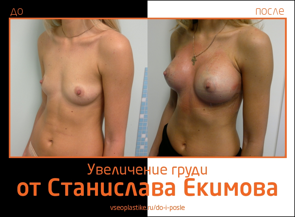 Станислав Екимов. Фото до и после увеличения груди