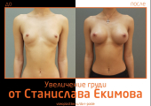 Станислав Екимов увеличение груди
