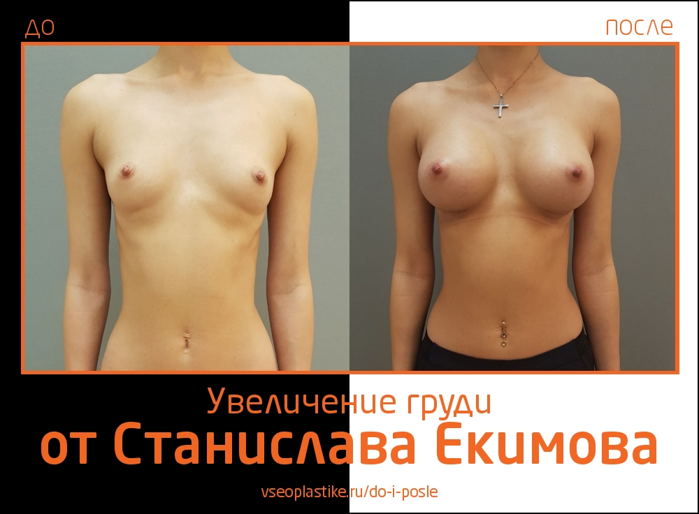 Станислав Екимов. Фото до и после увеличения груди
