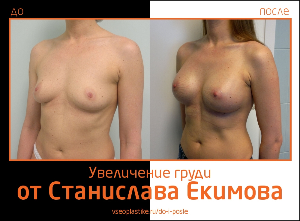 Станислав Екимов. Фото до и после увеличения груди