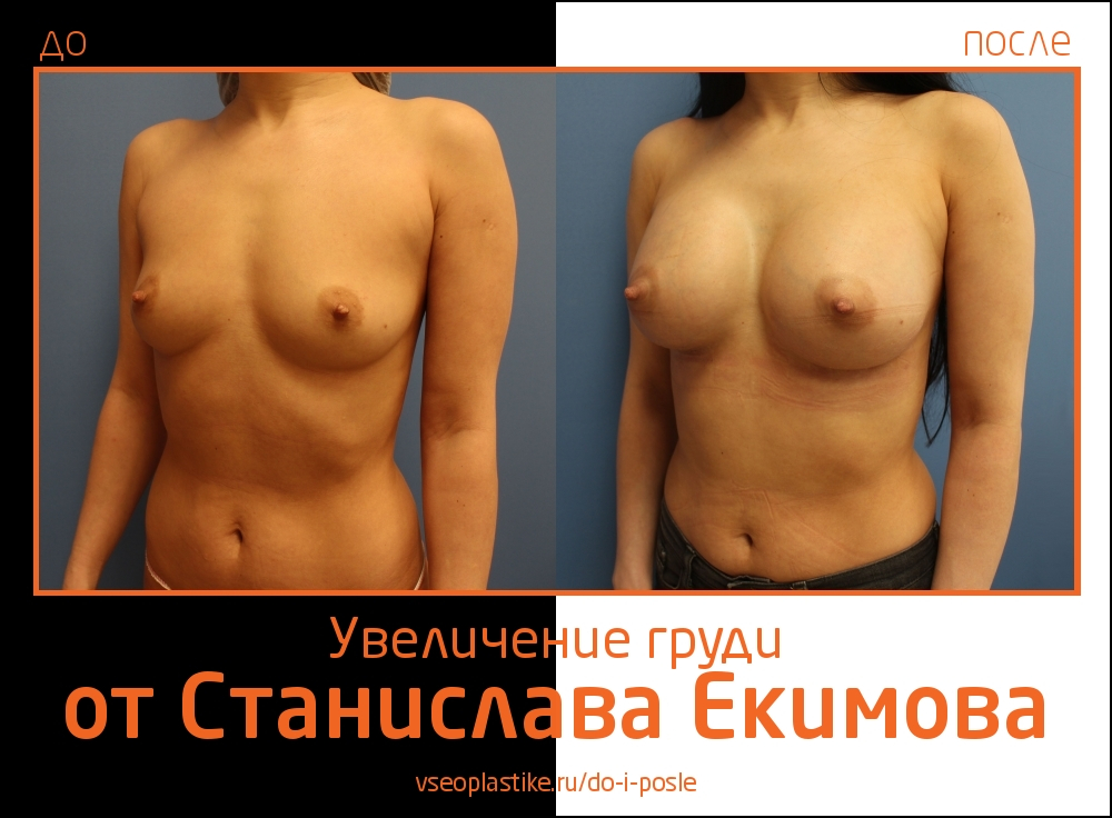 Станислав Екимов. Фото до и после увеличения груди
