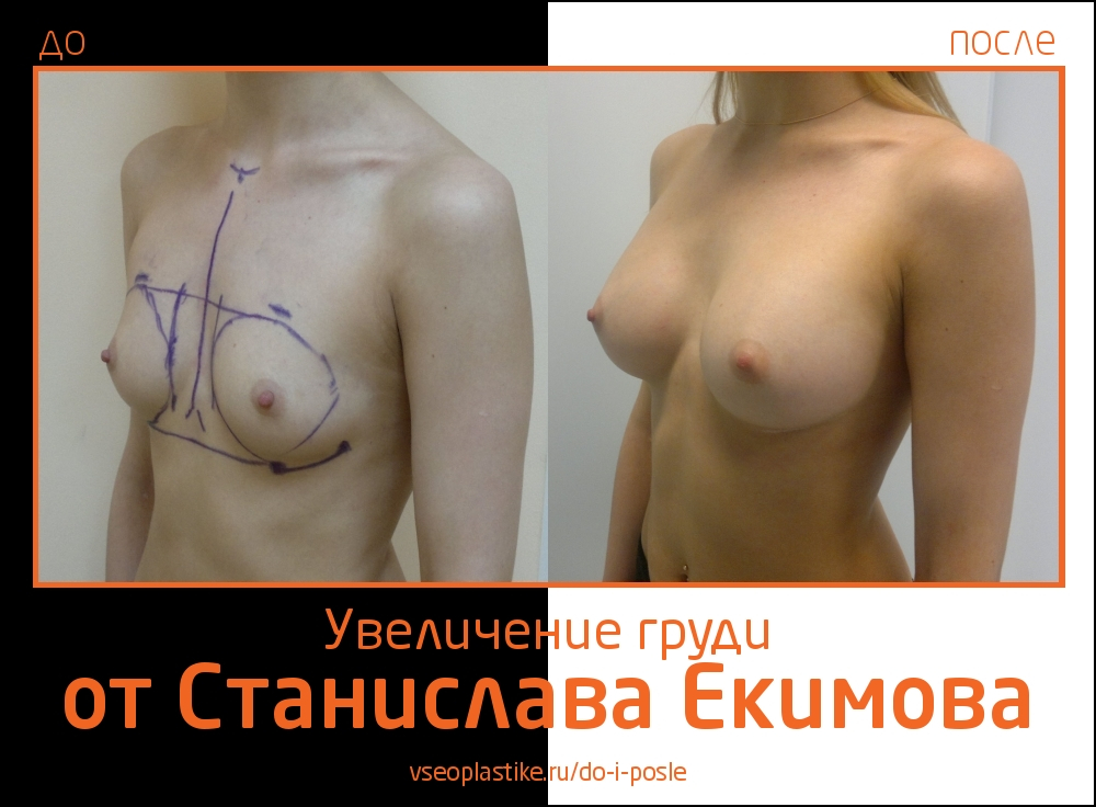 Станислав Екимов. Фото до и после увеличения груди