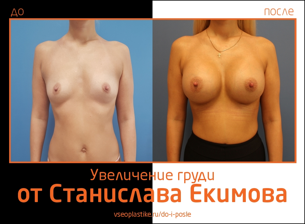 Станислав Екимов увеличение груди