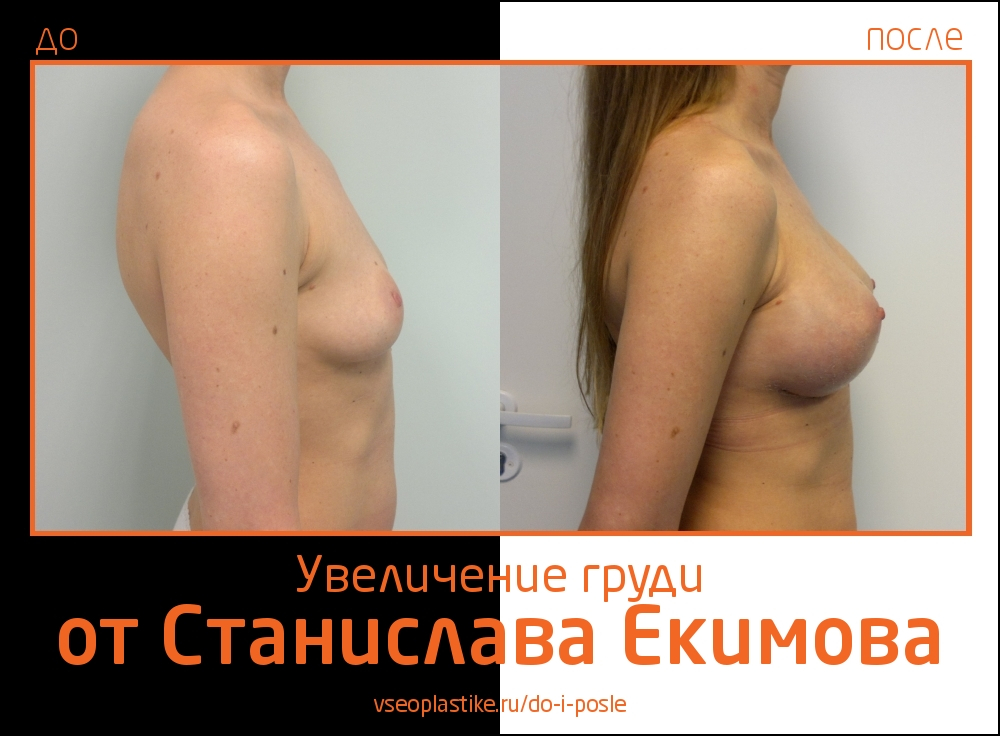 Станислав Екимов. Фото до и после увеличения груди