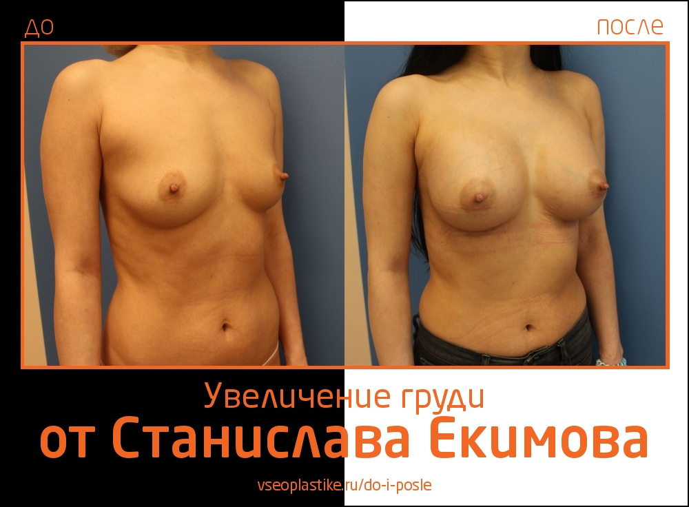 Станислав Екимов. Фото до и после увеличения груди