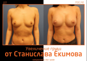 Станислав Екимов. Фото до и после увеличения груди