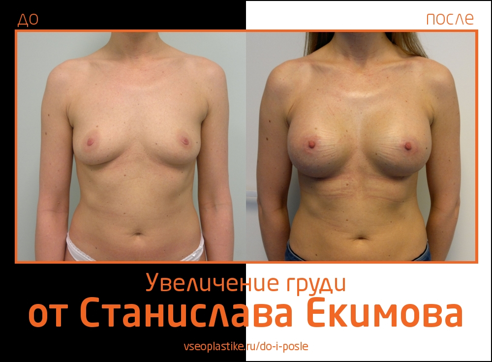Станислав Екимов. Фото до и после увеличения груди