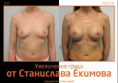 Станислав Екимов. Фото до и после увеличения груди