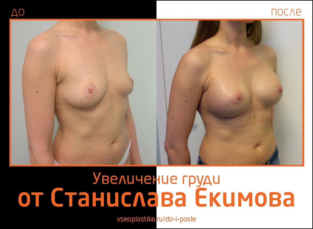 Станислав Екимов. Фото до и после увеличения груди